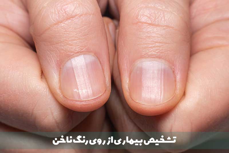 رنگ ناخن نمایان‌گر چه بیماری است؟